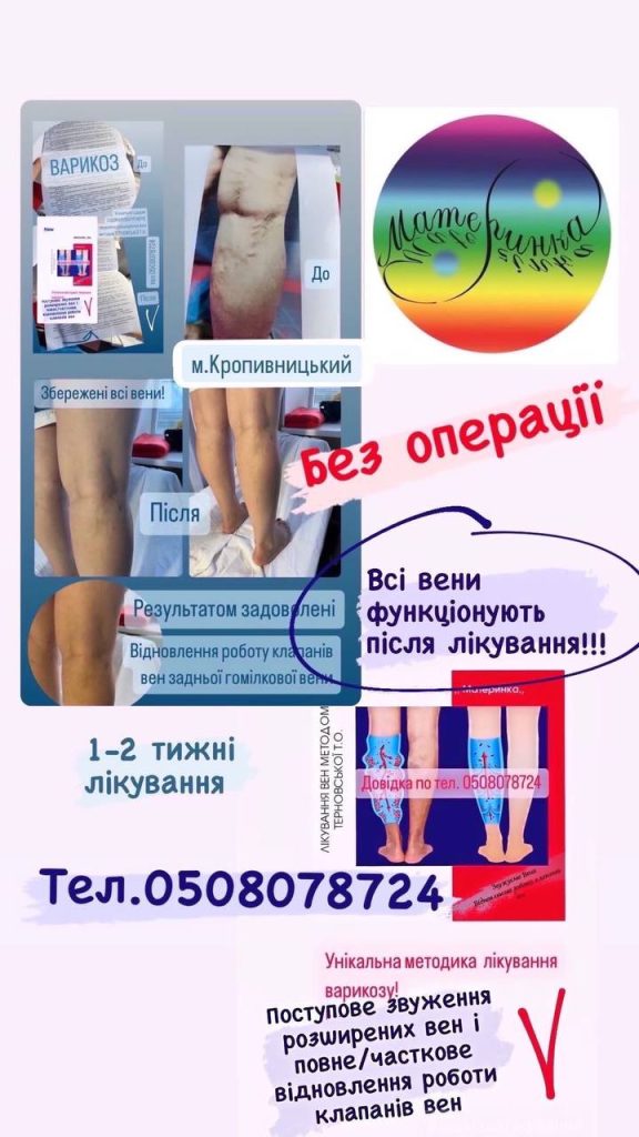 без операції лікуємо варикоз унікальним методом Терновської Т.О.